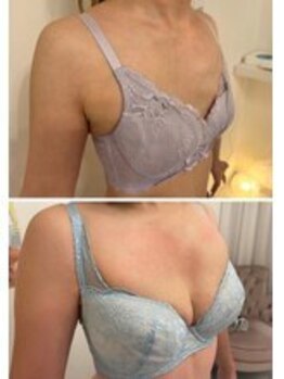 ベルビューティー(belle beauty)/【胸のたるみ・垂れ乳改善】症例