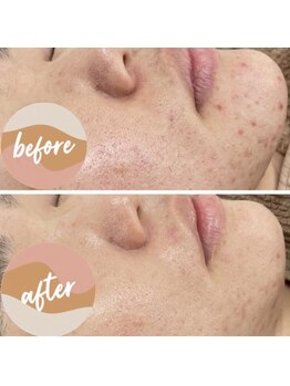 カルディエ(Cardie)/肌質改善　ビフォーアフター