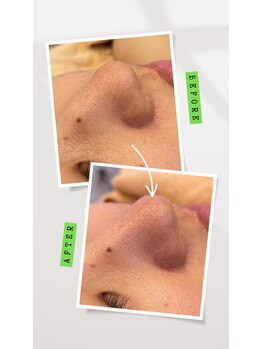 シェービングアンドエステ ブランピュア(Blanc pur)/毛穴レスシェービング60分