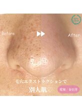モエラビューティーサロン(Moela beauty salon)/【全顔毛穴洗浄】