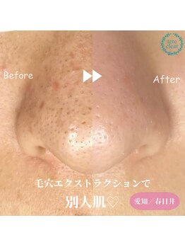 モエラビューティーサロン(Moela beauty salon)/【全顔毛穴洗浄】