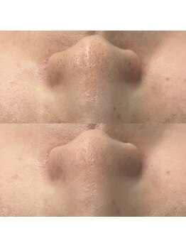 ヴェルシック(Belchic)/毛穴の引き締め効果もある!