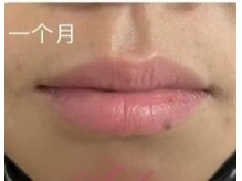 サクラピンク(SAKURA PINK)の雰囲気（リップエステを受けて１ヶ月後の結果）