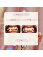 プラスビーセルフ(+b self)/ホワイトニングビフォーアフター