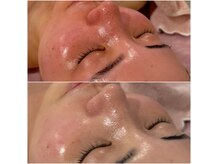 毛穴/くすみ/たるみ/ニキビ/肌トラブルケア全てお任せください♪