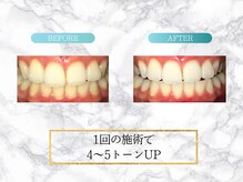 ロイヤル(ROYAL)/【ホワイトニング】before/after