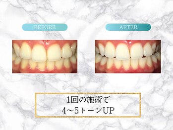 ロイヤル(ROYAL)/【ホワイトニング】before/after