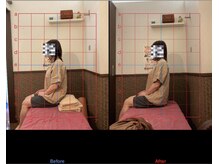 チャチャエイム整骨院 鍼灸院/猫背矯正ビフォーアフター