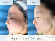 ビー(Be.)/プラズマ効果