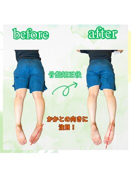 リコア(Re`core)/術後のビフォーアフター【骨盤】