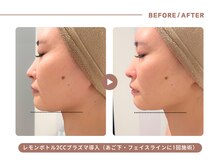 イエス マイサロン(yes My Salon)/レモンボトル施術例