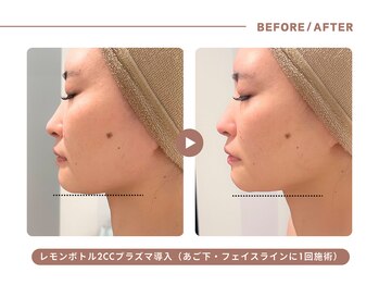 イエス マイサロン(yes My Salon)/レモンボトル施術例