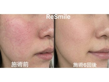 リスマイル 船橋(Re Smile)の写真/透明感のある肌へ導くエレクトロポーション！シミケアから脱毛まで叶うサロン◎