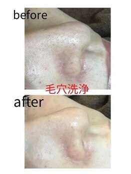 エヴァーグレース 河原町店/京都河原町の毛穴改善美肌サロン