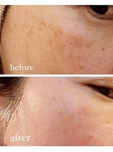 ジーニー(Genie)/リベル　ハーブピーリング　