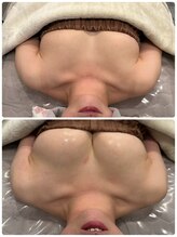 マイントゥー(mine too)/バストアップ症例