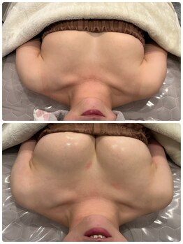 マイントゥー(mine too)/バストアップ症例