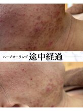 サロン ド エン(Salon de. en)/肌質改善◇ハーブピーリング