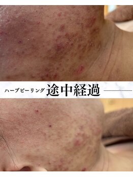 サロン ド エン(Salon de. en)/肌質改善◇ハーブピーリング