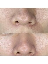 ブルーム(bloom)/ハーブピーリング/ララピール