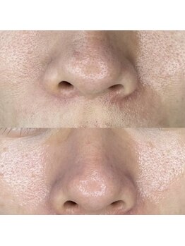 ブルーム(bloom)/ハーブピーリング/ララピール