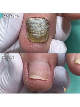 巻き爪補正店 千葉店の写真/もう悩まない！どこに行っても改善しない爪を、元の正常な爪へと導くケア技術で美しく☆