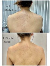 エンチャント(ENCHANT)/痩身超音波リフト6回でもう別人