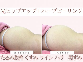 Cスキンケアクリニック 麻布店/光+ハーブピーリングBeforeAfter