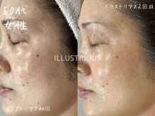 ミコサロン(miko salon)/ホワイトニングピーリング