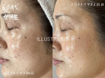 ミコサロン(miko salon)/ホワイトニングピーリング