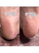 クレール(Clair)/フット足裏角質ケアの施術前と後