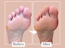 ベベ(Bebe)/50代女性/タコ・ガサガサお悩み