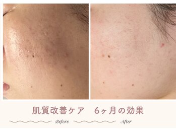 エステティックサロン シーズ/滑らかなはだに♪