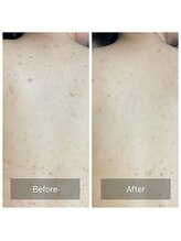 アーユルヴェーダアンドアロマエステ アユス(AYUS)/ハーブピーリング背中