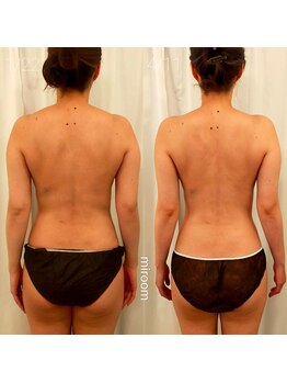 ミールーム(mi room)/痩身エステ２ヶ月半