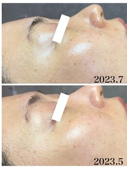 ココ(COCO)/ハーブピーリング/REVI /高知