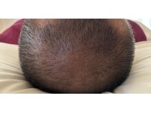 ボニータ(Bonita)/(ヘッド)ヒト羊膜幹細胞エステ