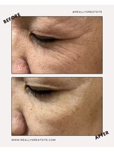 ユーフォリア(Euphoria)/シワ改善、くすみもクリアに