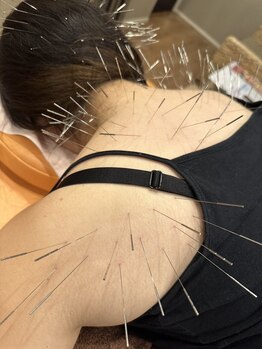 ミッツ(MITTU)の写真/慢性的な肩こりや腰痛にお悩みの方必見！特別なルート鍼が頑固なコリを解消し全身スッキリを叶えます♪