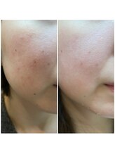 オリス(Oris)/グリーンピールbefore/after