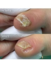 巻き爪補正店 市川駅前店/ 副爪