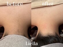 リエラ(Liella)/【うなじ脱毛】