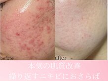 ファニービー 茨木店/20代 ニキビ 10回の施術変化