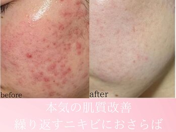 ファニービー 茨木店/20代 ニキビ 10回の施術変化
