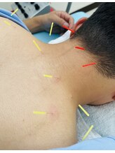 そら鍼灸整骨院/首・肩コリ、痛み ★鍼灸★