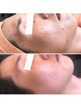 ヴィヴィ(ViVi)/男性も♪HAAB REPRO ピーリング