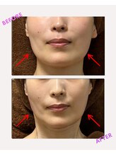 ユーフォリア(Euphoria)/痩せている方でも更に効果が