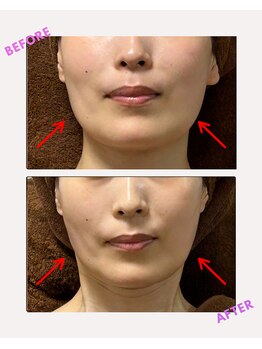 ユーフォリア(Euphoria)/痩せている方でも更に効果が