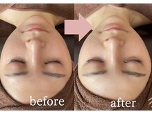 ナルシス(Narcissus)/ハーブピーリングbefore→after