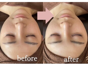 ナルシス(Narcissus)/ハーブピーリングbefore→after